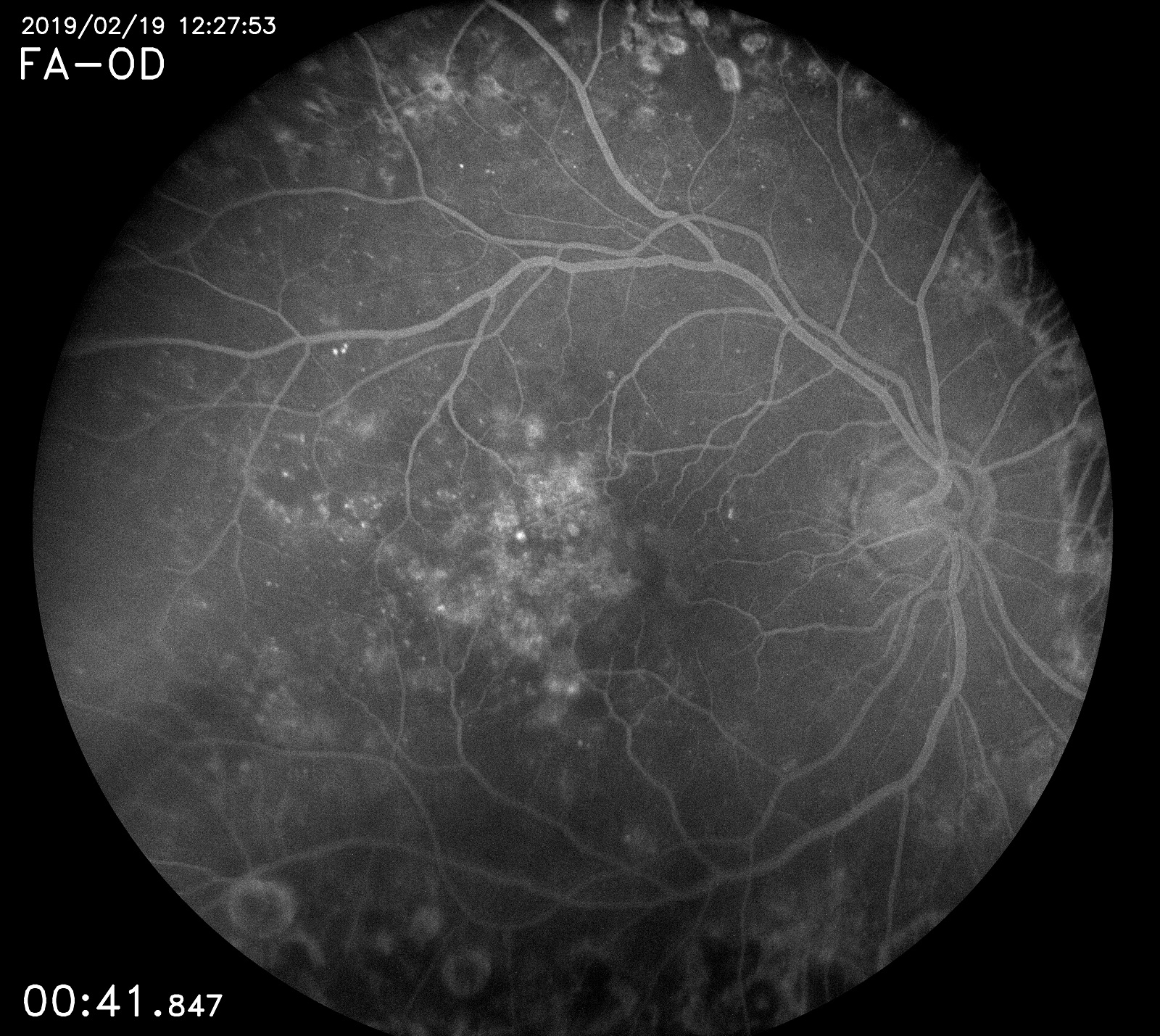 La Retinopatia Diabetica